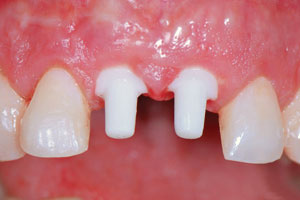 Metal-Free Dental Implants Melbourne