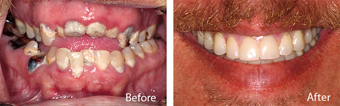 before and after treatment at Sheldon and Furtado, PLLC