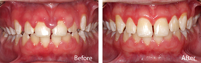 before and after treatment at Sheldon and Furtado, PLLC