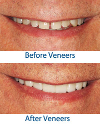 after porcelain veneers
