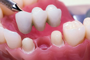 dental bridge being placed