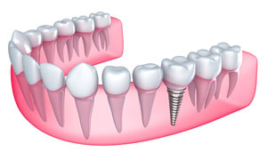 dental implant with post shown