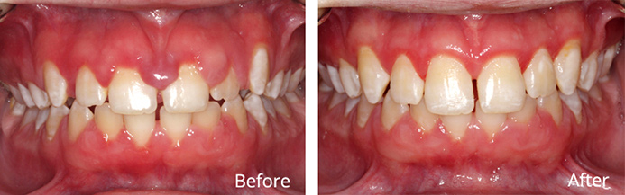 before and after gingivectomy