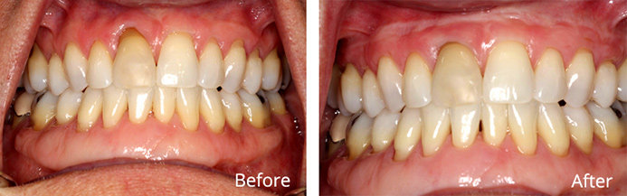 before and after treatment for gum recession