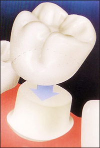 Dental crown