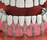 dentures stabilized by five implants each