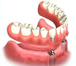 3d model of denture stabilization