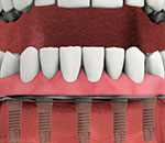 3D model of denture stabilization