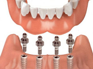 denture stabilization as part of full mouth rehabilitation