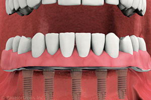 teeth replacement with dental implants