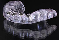 dental implants