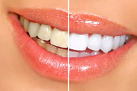 teeth whitening results