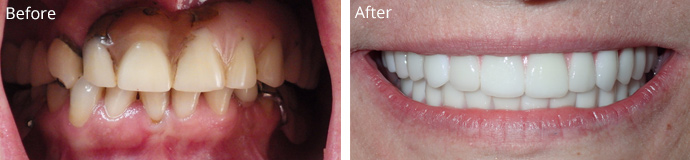 Before and after treatment at Sheldon and Furtado, PLLC