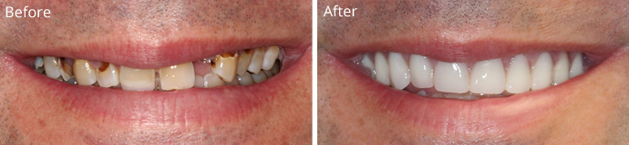 Before and after treatment at Sheldon and Furtado, PLLC