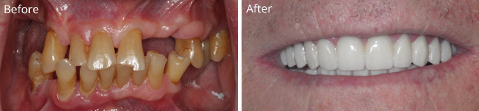 Before and after treatment at Sheldon and Furtado, PLLC