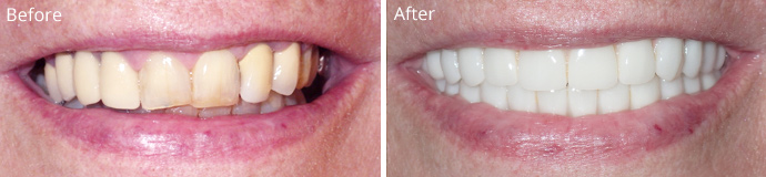 Before and after treatment at Sheldon and Furtado, PLLC