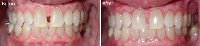 Before and after treatment at Sheldon and Furtado, PLLC