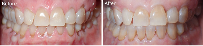 Before and after treatment at Sheldon and Furtado, PLLC