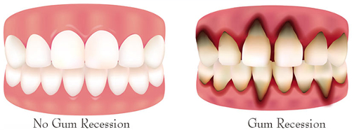 no gum recession vs gum recession
