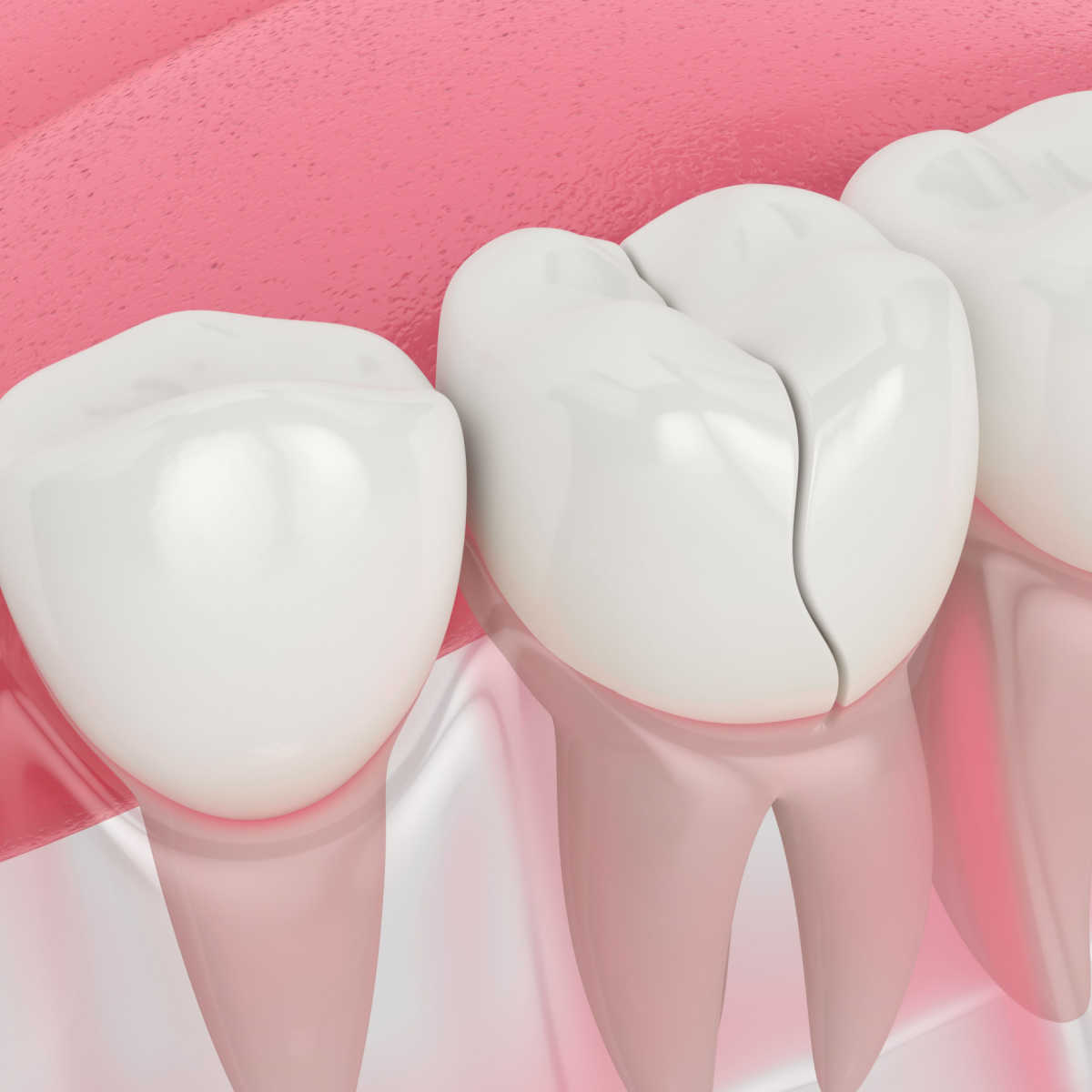 3D diagram of broken tooth