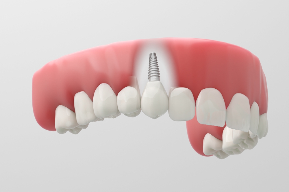 3D rendering of zirconia dental implant