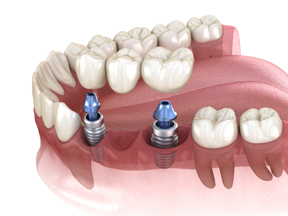 3D diagram of implant-supported dental bridge