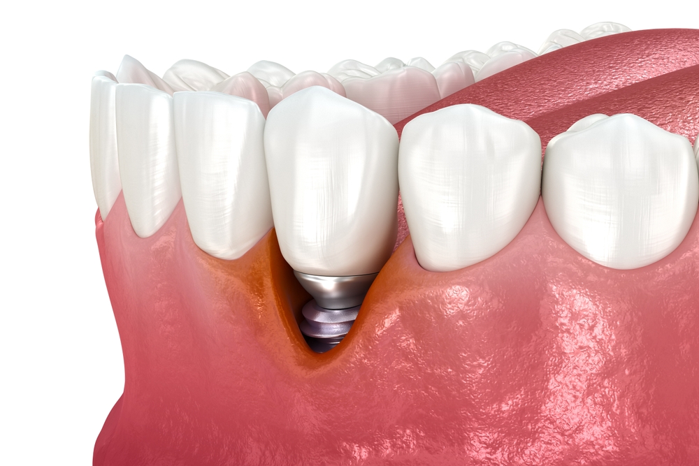 signs of peri-implantitis