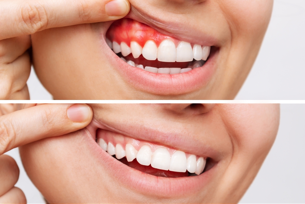 gum disease