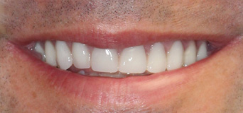 Patient smile after FMR treatment