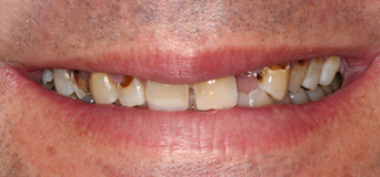 Patient smile before FMR treatment