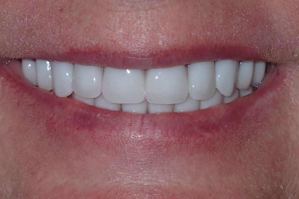 After image