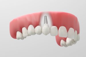 3D rendering of zirconia dental implant
