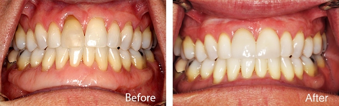 Gum Tissue Grafting Before and After