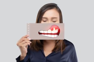 diagram of tooth abscess