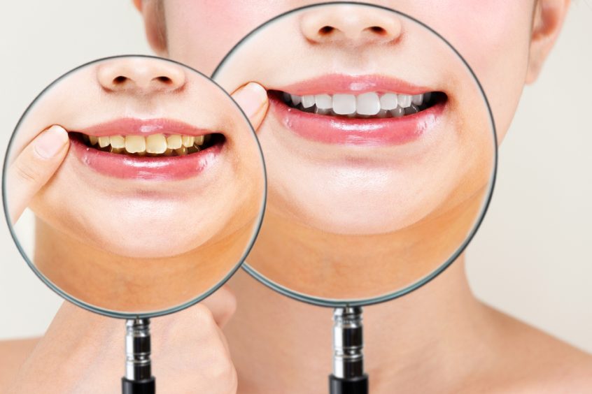 yellow teeth and white teeth magnified