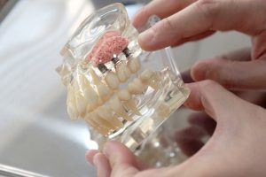 clear plastic diagram of dental implants in upper jaw