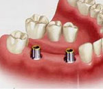 multiple-teeth replacement