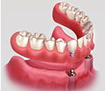 Denture Stabilization