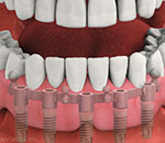 Denture Dentist Melbourne