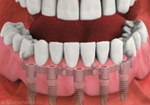 Implant-Supported Dentures