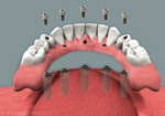 Solid Bite procedure