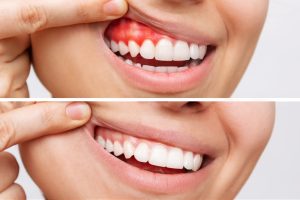 gum disease