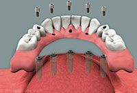 Solid Bite Teeth Replacement