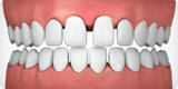 widely spread teeth