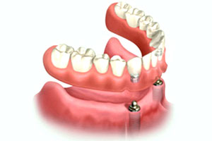 Denture Stabilization Melbourne